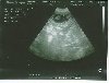  - Gestation confirmée par échographie
