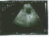  - gestation confirmée par échographie